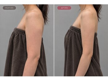 リフト 静岡(Lift)の写真/【1回でも変化を実感】二の腕・ハミ肉を集中ケア◎写真映えする華奢見えラインへ
小顔/二の腕/たるみ