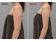 リフト 静岡(Lift)の写真/【1回でも変化を実感】二の腕・ハミ肉を集中ケア◎写真映えする華奢見えラインへ
小顔/二の腕/たるみ