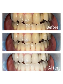 フィールグルック(Viel Gluck)/プレミアムセルフホワイトニング