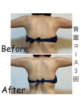 ナニワ ビューティー(naniwa beauty)/背面WINBACK痩身