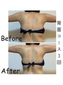 ナニワ ビューティー(naniwa beauty)/背面WINBACK痩身