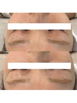 ヴェルシック(Belchic)/お悩みの方も多い瞼もお任せ