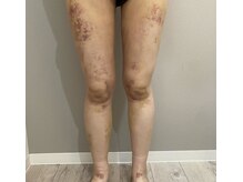 サロンシファ(salon sifa)/術後ケア