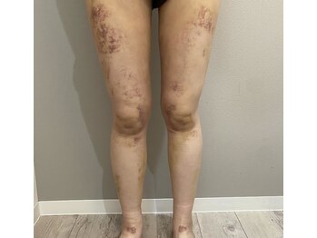 サロンシファ(salon sifa)/術後ケア