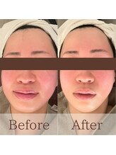 凪眠/小顔リンパフェイシャルの効果52