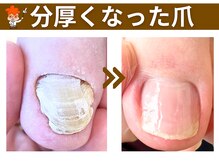 ポドウオーク(PODO WALK)/分厚くなった爪