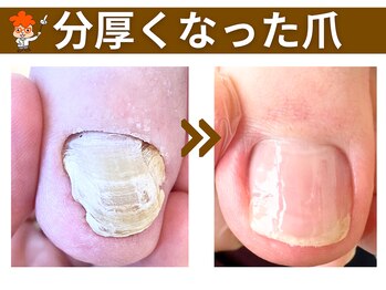 ポドウオーク(PODO WALK)/分厚くなった爪