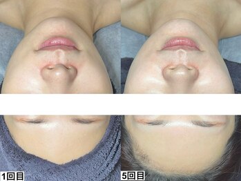 和歌山ララピール&韓国肌管理専門店/ララピール【艶肌/美白/くすみ】