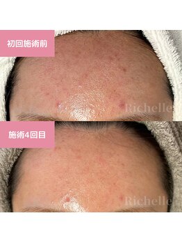 リシェル(Richelle)/ 【グリーンピールポアーズ】