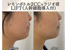 イーラボ 池袋店(e-LABO)/レモンボトル+ラジオ波Lift