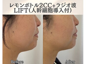イーラボ 池袋店(e-LABO)/レモンボトル+ラジオ波Lift