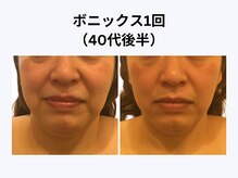 アユアラングレース/40歳後半・1回/法令線・小顔