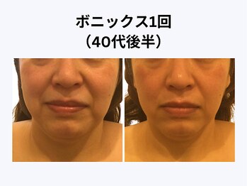 アユアラングレース/40歳後半・1回/法令線・小顔