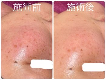 フォーチューン/ハーブ×シミの改善