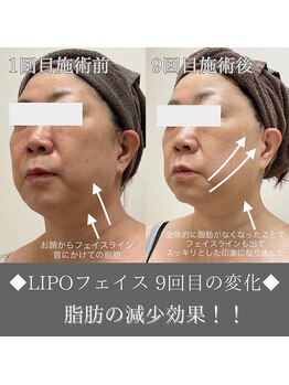 ナンバーファイブクリニカルサロン 札幌店(No.5)/BeforeAfter/小顔&リフトアップ