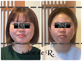 サロン ド アール(salon de R.)/【小顔骨氣・3回の施術効果◎】