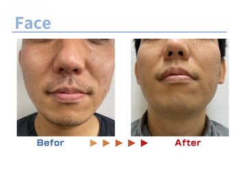 キングスサロン 熊本/メンズ髭脱毛ビフォーアフター