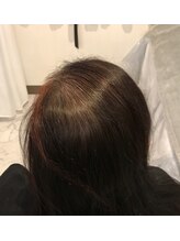 アブソリュートワン(absolute1)/頭髪育毛促進☆エクソソーム