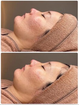 ホワイトアクア 京都店(WHITE AQUA)/ララピール/毛穴/京都