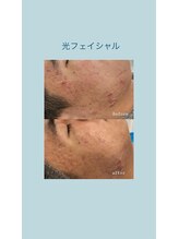 ウルト アルティメイトスキン(ULT ultimate skin)/シミ改善