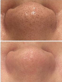 脱毛メリー/鼻の黒ずみ、お任せください