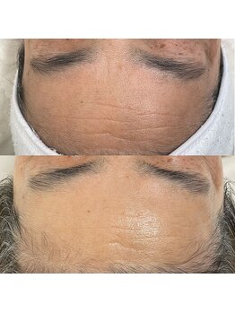 ソアン(Soin)/ダクトピール