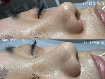 ナチュールムーン(Nature moon.)/毛穴洗浄
