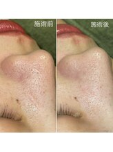 クレアーレ(creare)/ハイドロスキン・施術結果 7