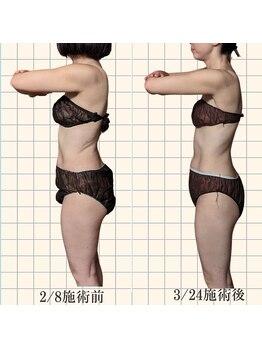 ルマ(Rumah)/筋膜リリースで痩身効果!