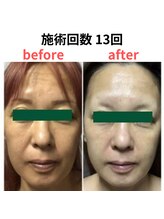 縁 整体院(en)/ハーブピーリング