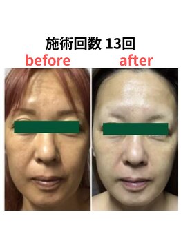 縁 整体院(en)/ハーブピーリング