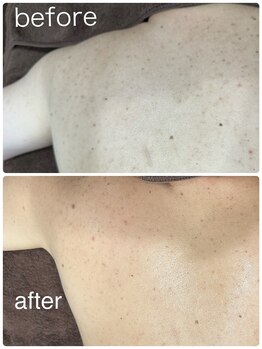 ビープラス(Biplus)/はく離あり　ハーブピーリング♪