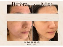 アンバー 恵比寿(AMBER)/ダウンタイム有ハーブピーリング