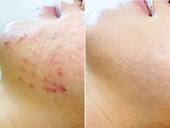 ハダイ(HADAY)/ニキビ改善｜ハーブピーリング