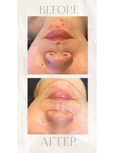 エムアイ 六本木(Mi)/水光ピール