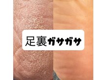 ビューティーベリッシモ(Beauty Bellissimo)/年齢を感じる足裏ガサガサ