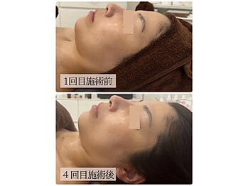 リノン(LINON)/ハーブピーリング 施術回数4回