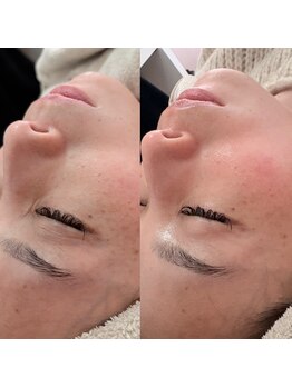 オンド(OND)/ハリ低下・くすみ改善