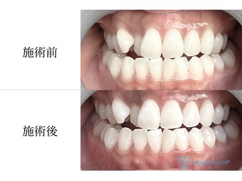 シュシュ(ChouChou)の写真/1ヶ月集中で白い歯を目指したい方におすすめ