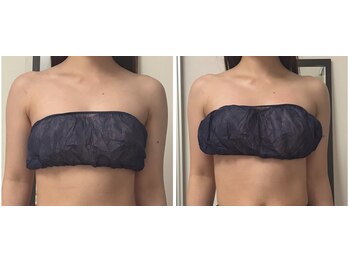 セルビューティー(Cell Beauty)/1回目での変化です