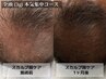 《育毛促進本気集中プラン》業界新技術★スカルプ棘ケア(全頭) ¥33000→