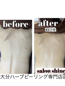 サロンシャイン(Salon Shine)/背中ハーブピーリング