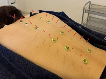 カワリカ(cawarIca)の写真/9割が寝落ち！？《美容鍼＋お身体の鍼灸セット100分》全身の疲労を改善し、心身共に健やかに☆
