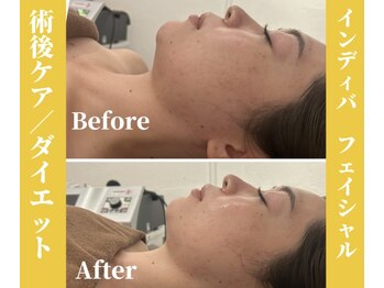 エミアンジュ(Emi Ange)/インディバフェイシャル