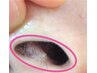★New★エチケット脱毛（鼻or眉or耳)粘膜に優しい光脱毛で確実に減毛◎