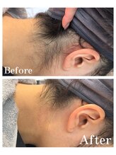 ピュア 川越店/うなじ脱毛