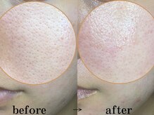 リーインカーナ アーティスト(REINCARNA ARTIST)/毛穴【ハイドラフェシヤル吸引】