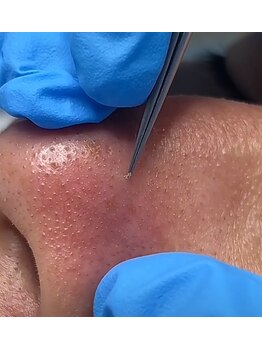 フレッシュ脱毛ドットコム(Flesh脱毛.com)/毛穴、角栓、ブラックヘッド除去