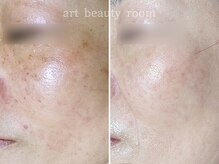 アート ビューティールーム(art beauty room)/☆OPL 光フェイシャル＆オーダー