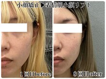 エミマス ボーテ(Emimas Beaute’)/毛穴洗浄×余白なしの小顔へ